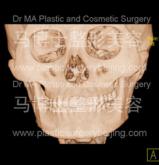 颌面骨较宽者的CT照片