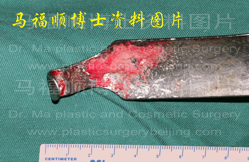 高速磨骨时磨下的骨骼碎末 高速磨骨时磨下的骨骼碎末