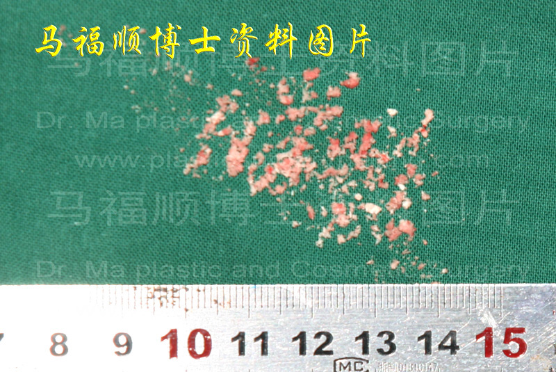 低速磨骨工具磨下的骨骼碎末 低速磨骨工具磨下的骨骼碎末