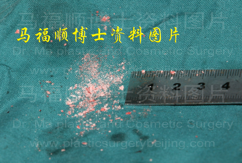 手动磨骨磨下的骨骼碎末 手动磨骨磨下的骨骼碎末