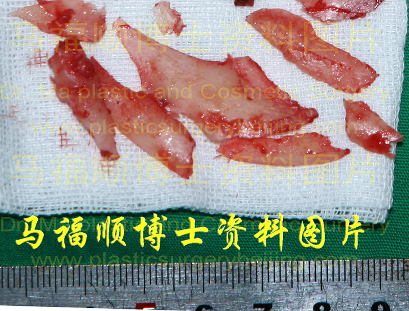 截骨所切下来的骨骼块 截骨所切下来的骨骼块