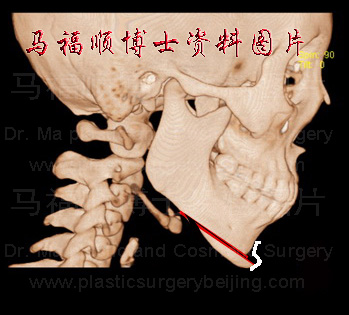 颏骨前移后固定 颏骨前移后固定