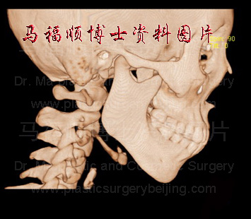 下巴后缩CT 下巴后缩CT