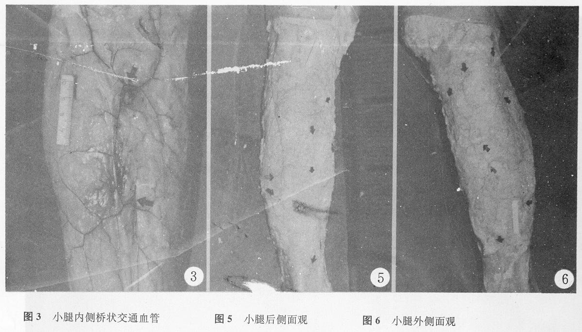 小腿皮动脉及其吻合 小腿皮动脉及其吻合