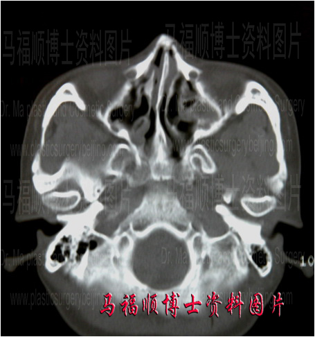 螺旋CT三维重建在颧骨颧弓整形术中的应用 – 马博士颌面整形美容专业知识网