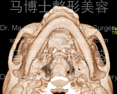 仰头位下颌骨外形 仰头位下颌骨外形