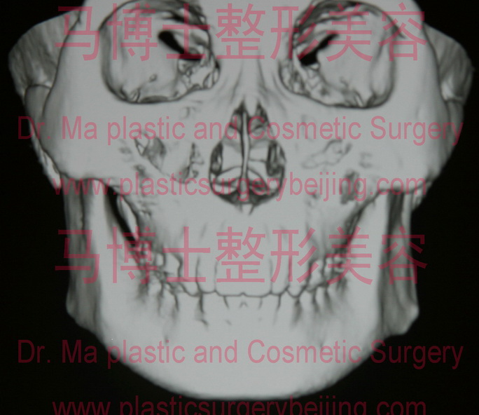 外翻的下颌角 外翻的下颌角