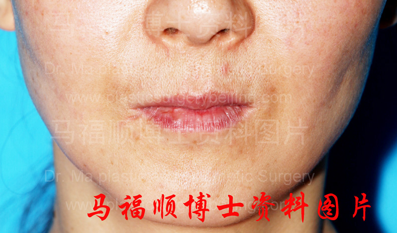 上下颌前突整形术后上唇变薄正面 上下颌前突整形术后上唇变薄正面