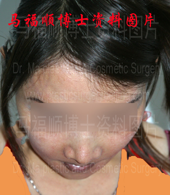 上下颌前突整形术后上唇变薄低头位 上下颌前突整形术后上唇变薄低头位