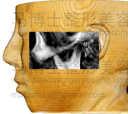 颧骨颧弓在面部投影侧面 颧骨颧弓在面部投影侧面