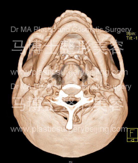 脸型瘦小者的颌面骨骼形状仰头位 脸型瘦小者的颌面骨骼形状仰头位
