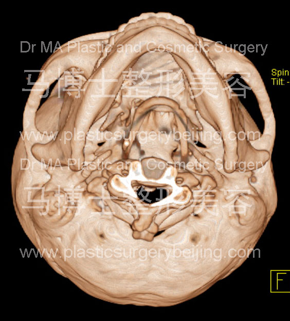 宽脸型者的颌面骨形状仰头位 宽脸型者的颌面骨形状仰头位