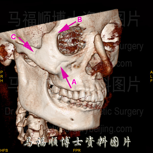 颌面骨的CT三维成像图片 颌面骨的CT三维成像图片