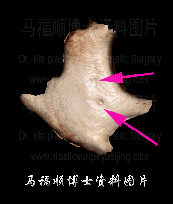 颧骨CT图片 颧骨CT图片