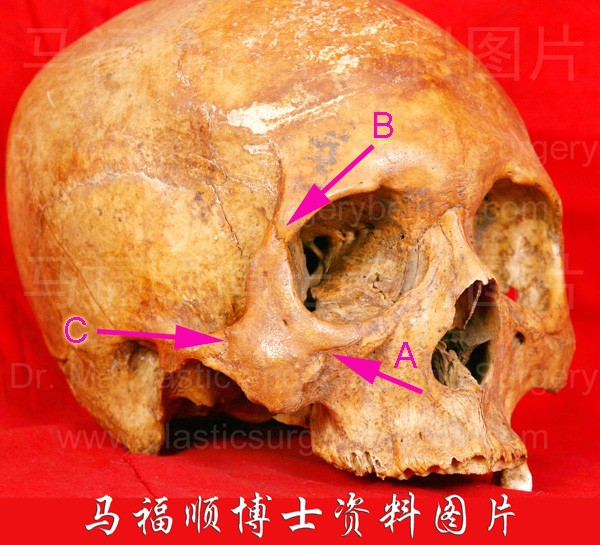 颧骨在颅骨上的位置 颧骨在颅骨上的位置