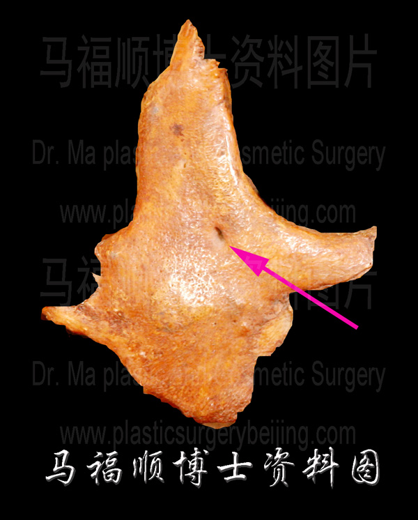 颧骨照片 颧骨照片