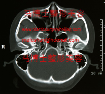 颧骨颧弓测量 – 马博士颌面整形美容专业知识网