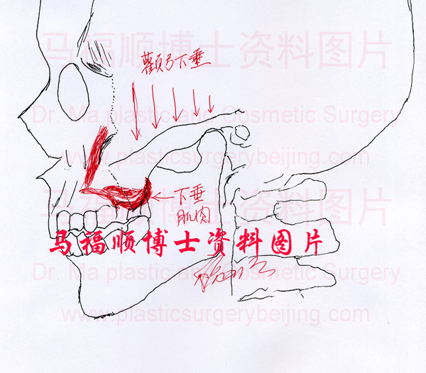 下垂的颧骨颧弓