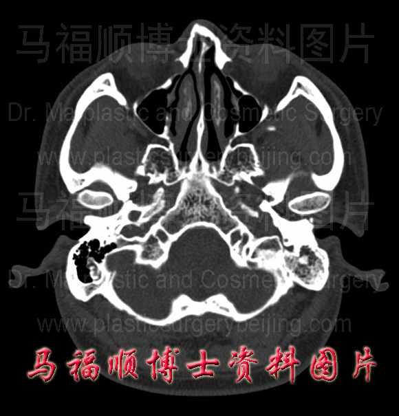 颧弓 – 马博士颌面整形美容专业知识网