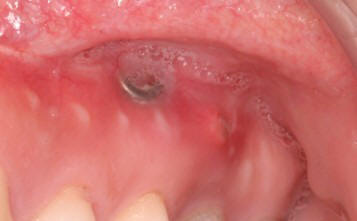 内固定钛钉外露 内固定钛钉外露