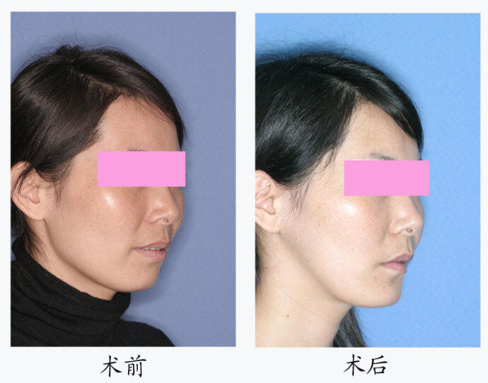 颌面整形术前及术后斜面 颌面整形术前及术后斜面
