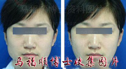 非手术所得的对比照片 非手术所得的对比照片