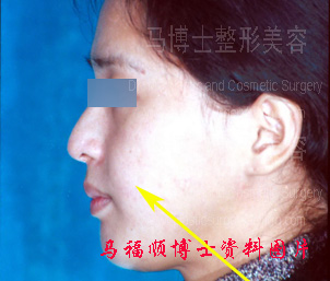 苹果肌下垂 苹果肌下垂