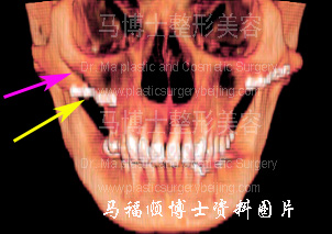 颧骨手术后下垂CT 颧骨手术后下垂CT