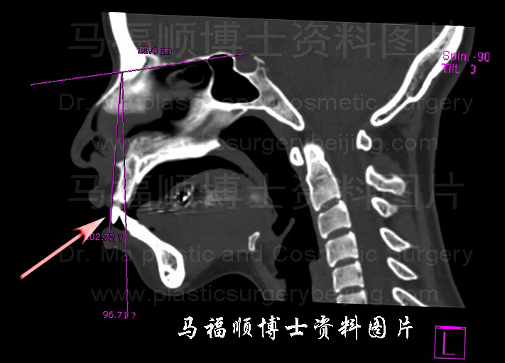 下颌骨断层解剖图谱图片