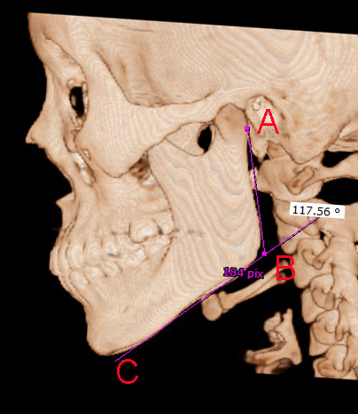 下颌骨解剖图ct横断图片